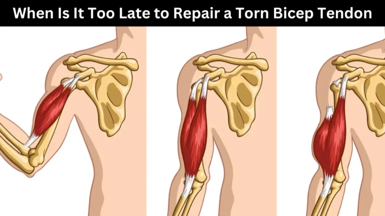 when is it too late to repair a torn bicep tendon